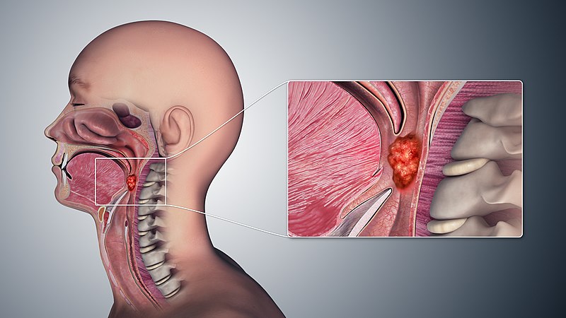 Throat Cancer Image